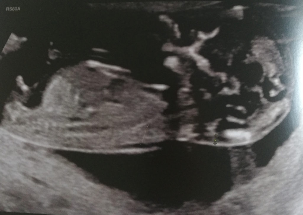 echographie 1er trimestre de grossesse
